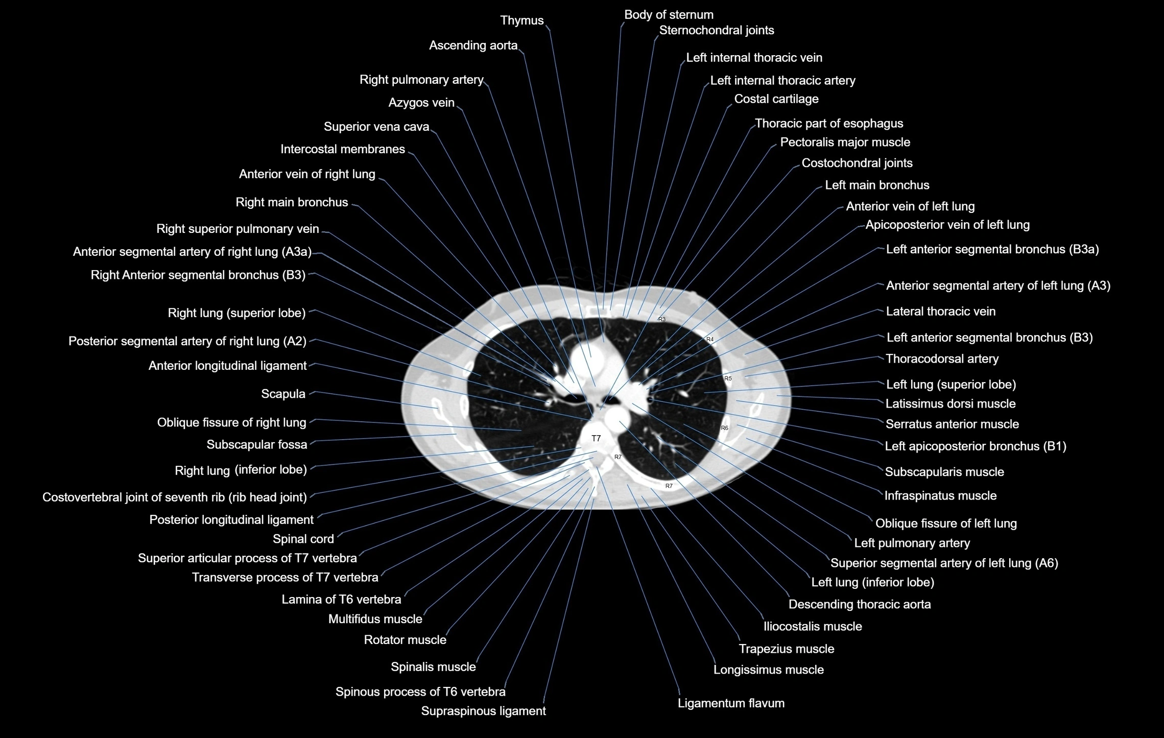 CT chest (thorax) lung window window labelled axial cross sectional anatomy radiology image-00051.webp